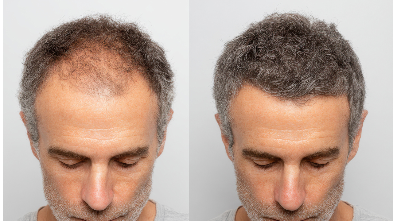 Before and after hair transplant result